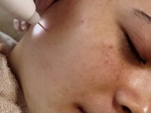 ユーヘン(uhem)/【PICO】シミケア♪