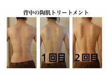 ラ リノ 星ヶ丘(La Lino)の雰囲気（お顔だけでなく背中の肌質改善に！さらに引き締め効果も◎）