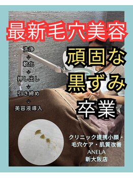 アネラ(ANELA)/毛穴エクストラクション症例.2