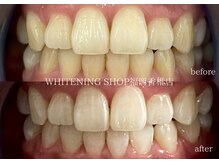 ホワイトニングショップ 福岡香椎店/美容ホワイトニングbefore after