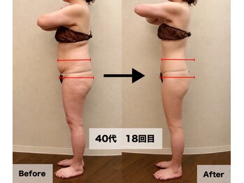 ドルチェエフェクト(dolce effect)の写真/【当店人気No,1施術セルゼロ】気になる脂肪を燃焼して自分らしい理想のボディーラインへ♪