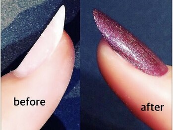 リアン(lien)/そり爪矯正