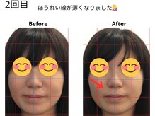 ベル/30代の方の小顔Before After
