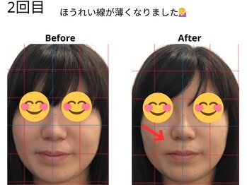 ベル/30代の方の小顔Before After