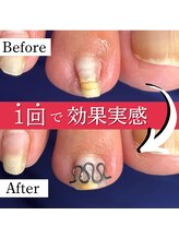 巻き爪矯正センター 沖縄 宜野湾/巻き爪矯正ビフォーアフター