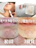 【毛穴＆ニキビケア】4step全顔毛穴洗浄+ハーブ配合角質ケアパック￥6000