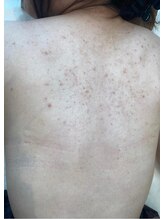 リベル 名古屋(Lebelle:)/ハーブピーリング専門名古屋