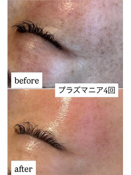 アヌヘア(Anuhea)/シミ悩みケアはプラズマニア