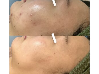 サロン ド グレイシャス エステティック(Salon de GRACIOUS esthetic)/育肌ハーブピーリング