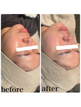 ディオーネ 春日井勝川店(Dione)/顔脱毛+毛穴洗浄