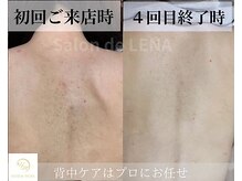 サロンドレナ 名駅店/ハーブピーリング サロンドレナ