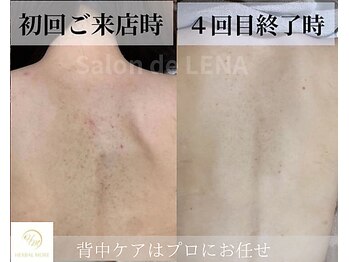 サロンドレナ 名駅店/ハーブピーリング サロンドレナ
