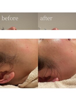 コモレビ(komorebi)/町田駅/フェイスワックス/顔脱毛