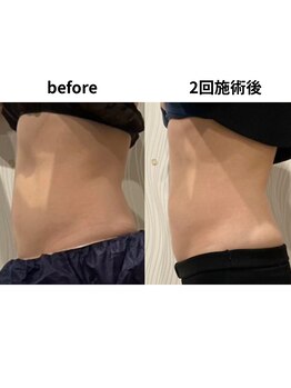 ダリアビューティー(Dahlia Beauty)/キャビテーション女性 上半身2回