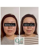 キュープ 静岡店(Qpu)/お顔がひと回り小さく！