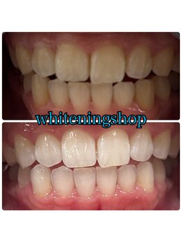 ホワイトニングショップ 三田店/before after