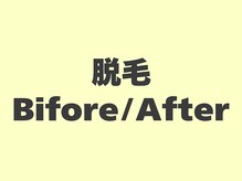 セルフメイド 東大阪店(SELFMADE)/セルフ脱毛ビフォーアフター