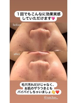 ライチャス(RAICHAS)/ハイドロフェイシャル