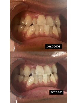 ダンニヒル(dannihil)/セルフホワイトニング1回目