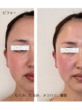 カモン(KAMON)/美顔矯正1回目