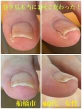 巻き爪じゅん 千葉駅前店/巻き爪本当に1回で変わった！