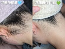 ムーン 横浜(MOON)の雰囲気（継続することで毛質や濃さの変化を実感♪）