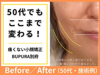 ブプラ 別府店(BUPURA)/別府で小顔矯正！50代の劇的変化