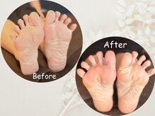 リブリース(RE:Bliss)/足つぼ後の変化