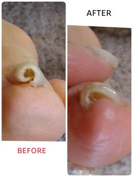 フットスタジオ アルク(FOOT STUDIO ALUK)/【ストロー状の巻き爪】