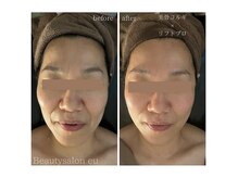 美骨コルギ×リフトプロ