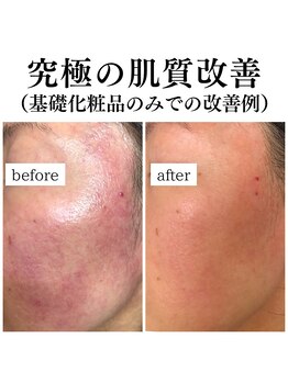 フェリス(FELIZ)/肌質改善Dr.ピュールボーテ