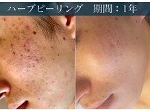 アリイ(Alii)の雰囲気（【ハーブピーリング】ダウンタイムなし！1回でも効果を実感♪）