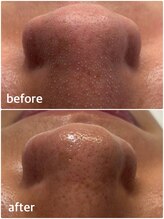 モテ 新宿店(Mote)/ハイドラ毛穴洗浄＋艶肌Wax 新宿