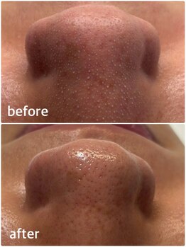 モテ 新宿店(Mote)/ハイドラ毛穴洗浄＋艶肌Wax 新宿