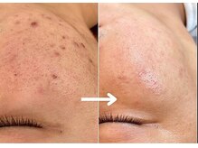 ソイ(Soi)/お肌のお悩みが解消！