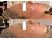 リスタ(RSTA)/【BEFORE/AFTER】