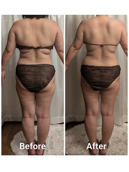 フィニシオン/40代　4回施術後ろ姿スッキリ