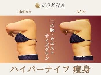 痩身専門店エステティックサロン コクア(KOKUA)/Before→After