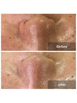 デザイン スペース アイリー(Design Space IRIE)/毛穴洗浄1回