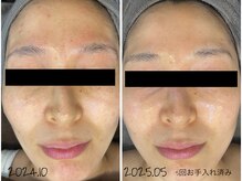 レイズ(RAISE)/当店人気No.1 水光ピーリング