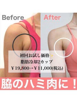 ゴールデンエイジ(Golden Age)/脇下脂肪冷却♪