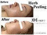 【リニューアル記念★】毛穴レス！肌質改善ハーブピーリング　¥3000　60分