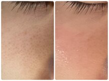 ルミエール フォレストサイド(L’MIERE forestside)の雰囲気（毛穴縮小◎毛穴ケアを続けていくと皮脂量を適量にコントロール）