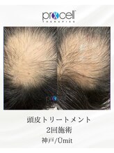 ユミト(Umit)/プロセルスカルプ