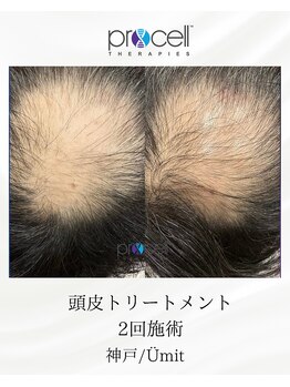 ユミト(Umit)/プロセルスカルプ