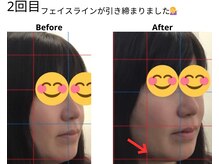 ベル/30代の方の小顔Before After