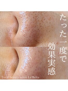 エステティックサロン ラ ベルタ(Esthetic Salon La Belta)/毛穴の黒ずみケア