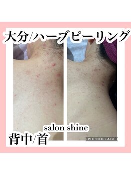 サロンシャイン(Salon Shine)/ハーブピーリング1回