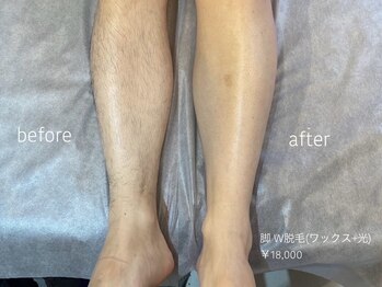 ワクシー 恵比寿店(WAXYYY.)/メンズ脚W脱毛)