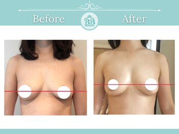 美人バスト 渋谷店/【バストアップ・育乳】症例☆